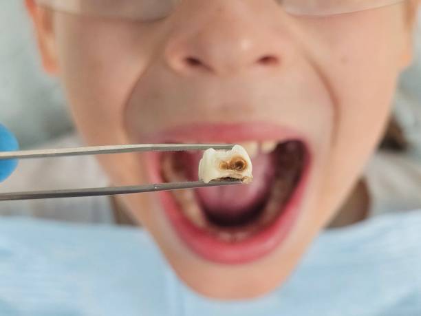Best Urgent Care for Lost Fillings or Crowns in Raymond, WI