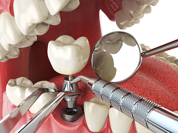 Best Emergency Tooth Extraction in Raymond, WI